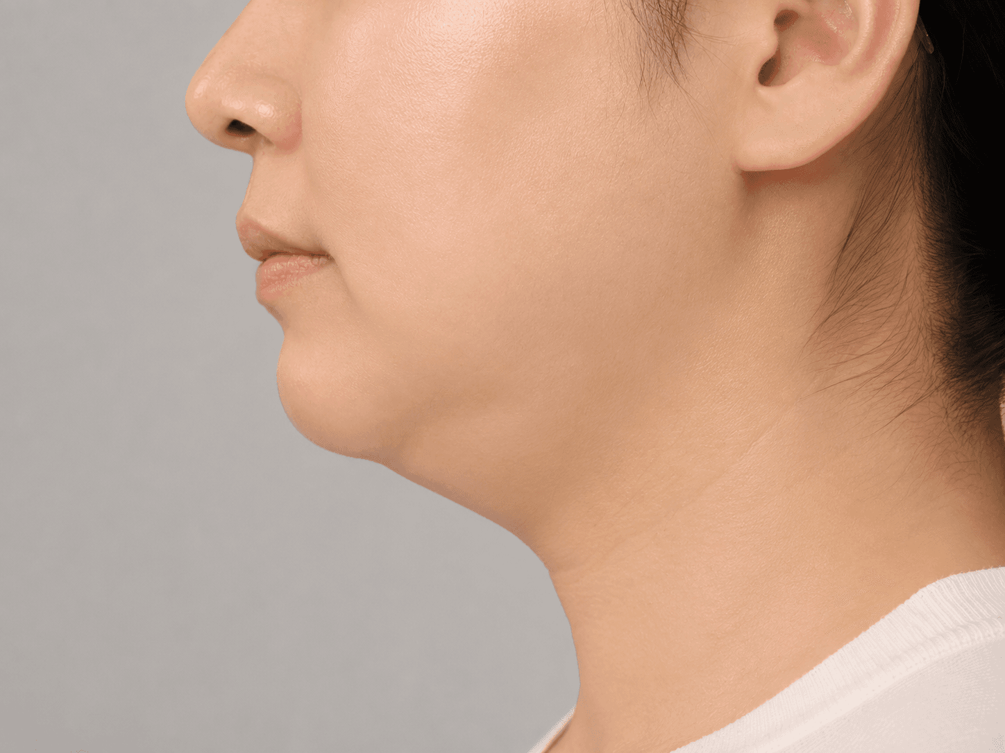 CASE 02 근육 사이·아래 지방이 많은 경우